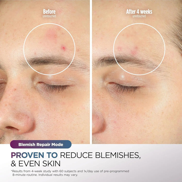 Shark CryoGlow LED Face Mask with Under-Eye Cooling, Anti-Ageing & Blemish Repair, Red & Blue LED, Infrared Light Therapy, USB-C, Remote Control, Storage Bag, Adjustable Straps